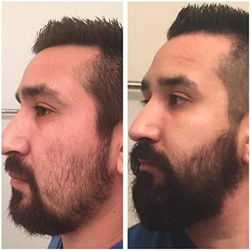 Kit De Croissance De Barbe  Avec Rouleau Dermique De 0,5 Mm Et Sérum De Croissance De Barbe De 30 Ml, Stimule La Croissance De La Barbe Chez Les Hommes
